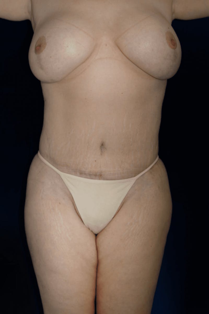 Tummy Tuck Before & After Gallery - Patient 281793 - Image 2
