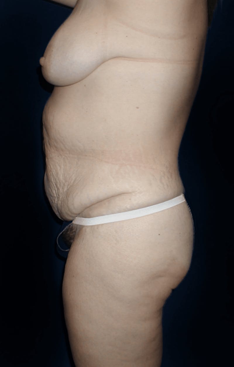 Tummy Tuck Before & After Gallery - Patient 281793 - Image 3