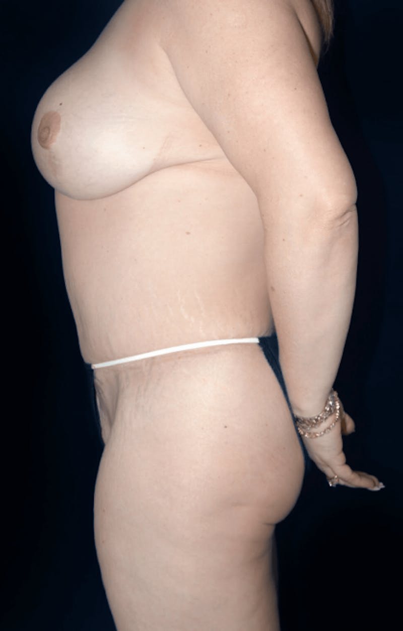 Tummy Tuck Before & After Gallery - Patient 281793 - Image 4