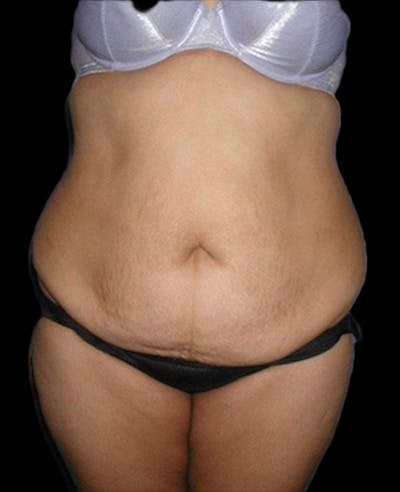 Tummy Tuck Before & After Gallery - Patient 923362 - Image 1