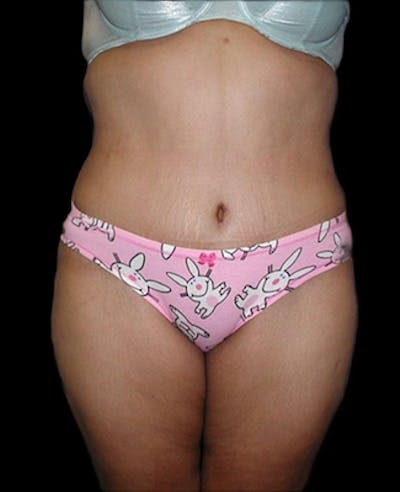 Tummy Tuck Before & After Gallery - Patient 923362 - Image 2