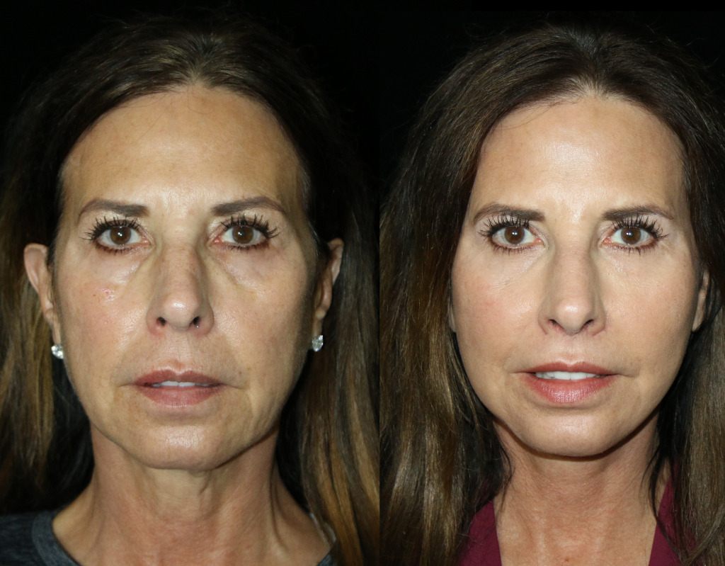 Before and After Facelift with ITR2