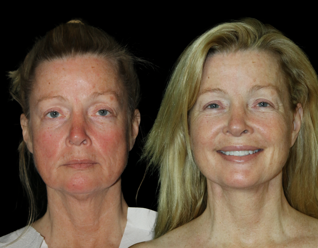 Before and After Facelift with ITR2
