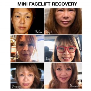 mini facelift recovery