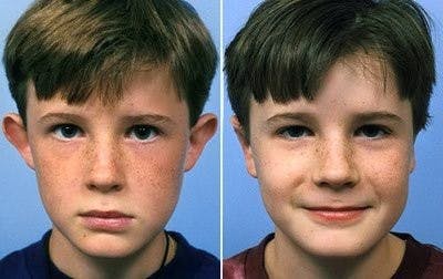 Otoplasty Before & After Gallery - Patient 287585 - Image 1