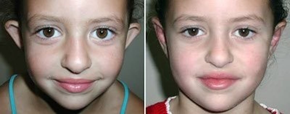 Otoplasty Before & After Gallery - Patient 670787 - Image 1