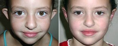Otoplasty Before & After Gallery - Patient 670787 - Image 1