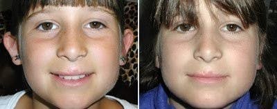 Otoplasty Before & After Gallery - Patient 915365 - Image 1