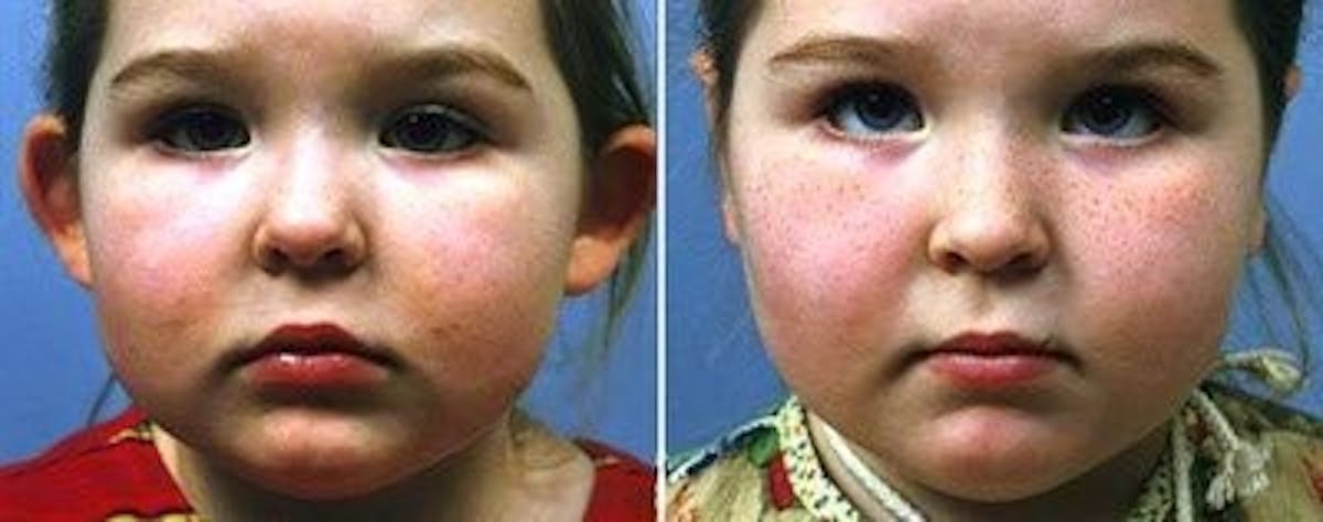 Otoplasty Before & After Gallery - Patient 387832 - Image 1