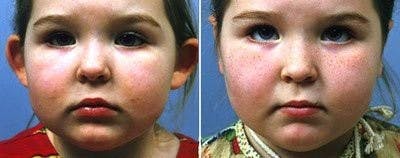 Otoplasty Before & After Gallery - Patient 387832 - Image 1