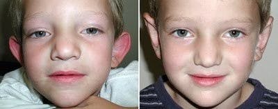 Otoplasty Before & After Gallery - Patient 163891 - Image 1