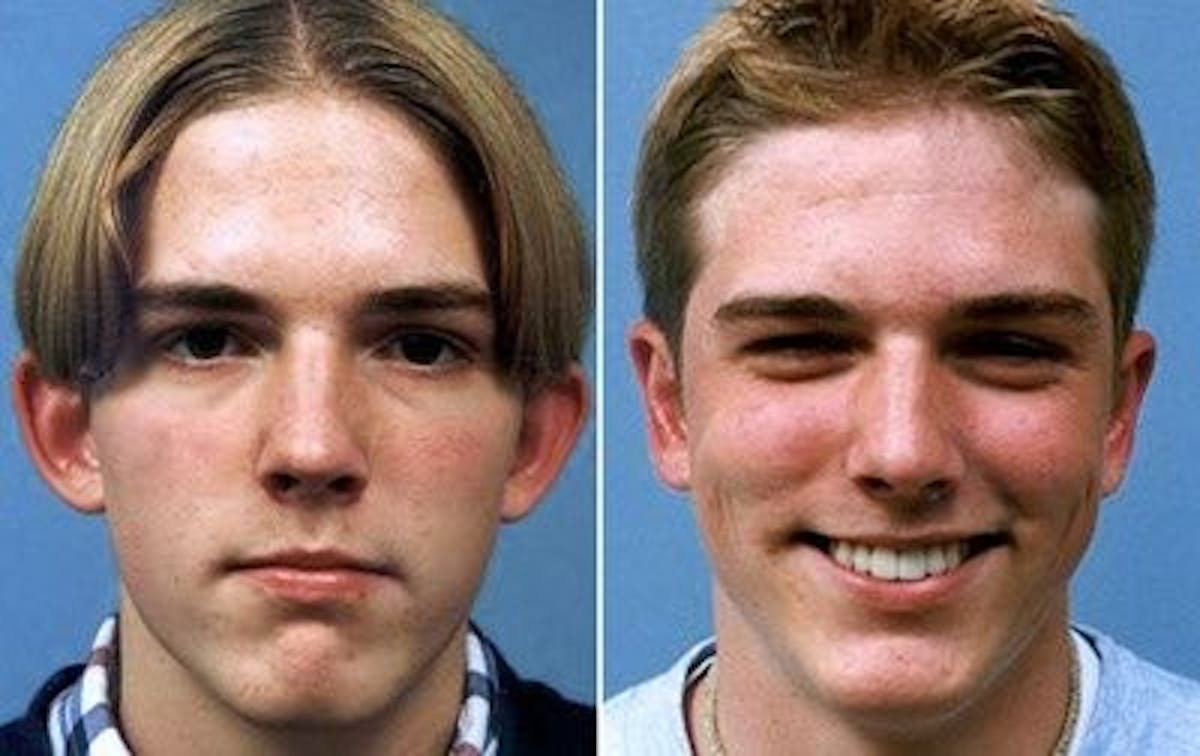 Otoplasty Before & After Gallery - Patient 255631 - Image 1