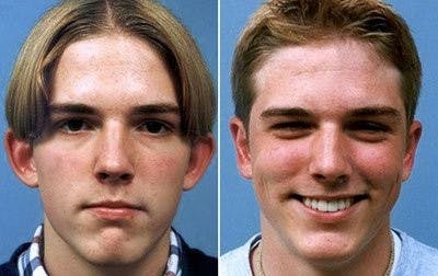 Otoplasty Before & After Gallery - Patient 255631 - Image 1