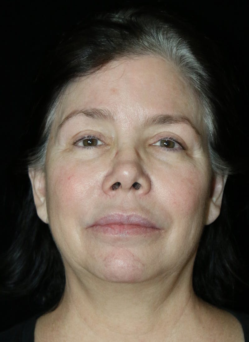 Facelift Before & After Gallery - Patient 417340 - Image 1