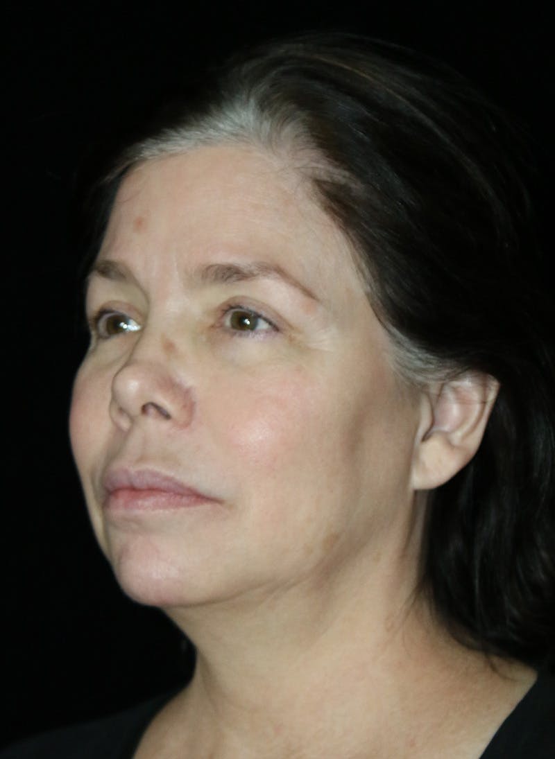 Facelift Before & After Gallery - Patient 417340 - Image 3