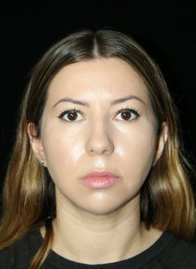 Buccal Fat Restoration Before & After Gallery - Patient 917041 - Image 1
