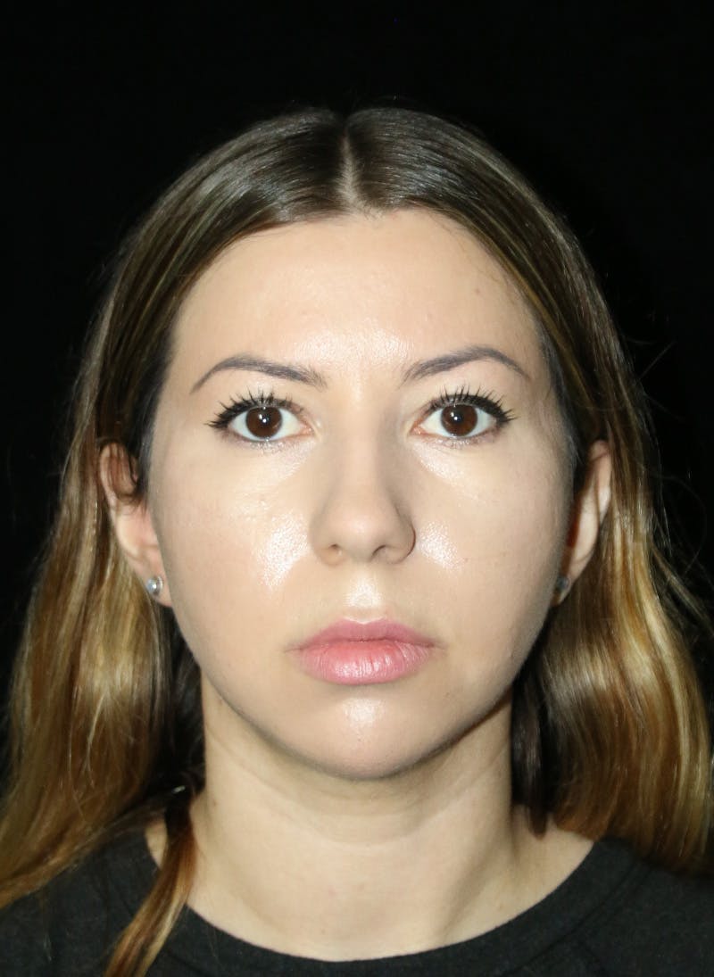 Buccal Fat Restoration Before & After Gallery - Patient 917041 - Image 1