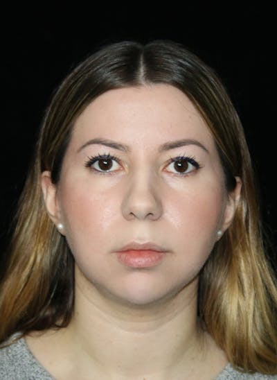 Buccal Fat Restoration Before & After Gallery - Patient 917041 - Image 2