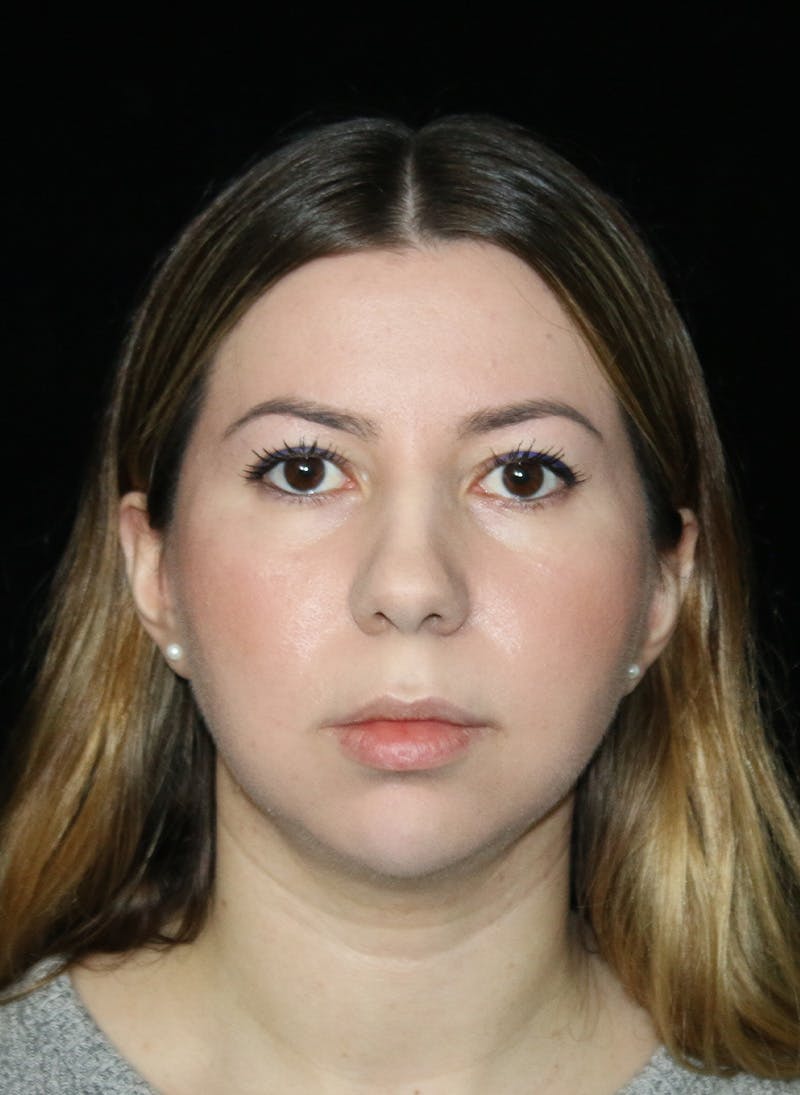 Buccal Fat Restoration Before & After Gallery - Patient 917041 - Image 2
