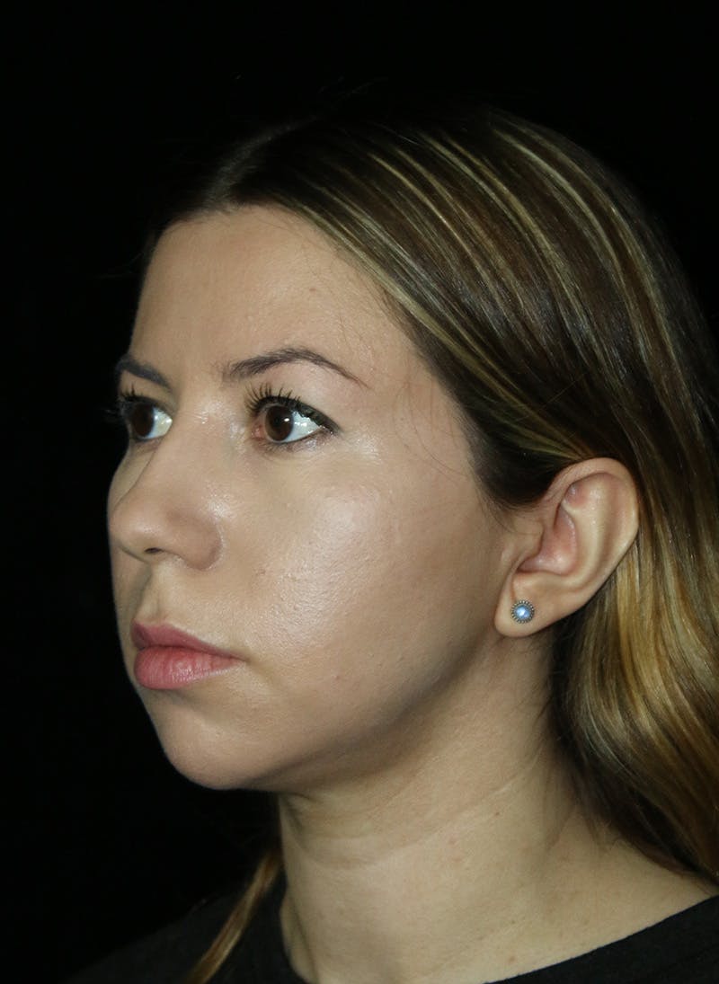 Buccal Fat Restoration Before & After Gallery - Patient 917041 - Image 4