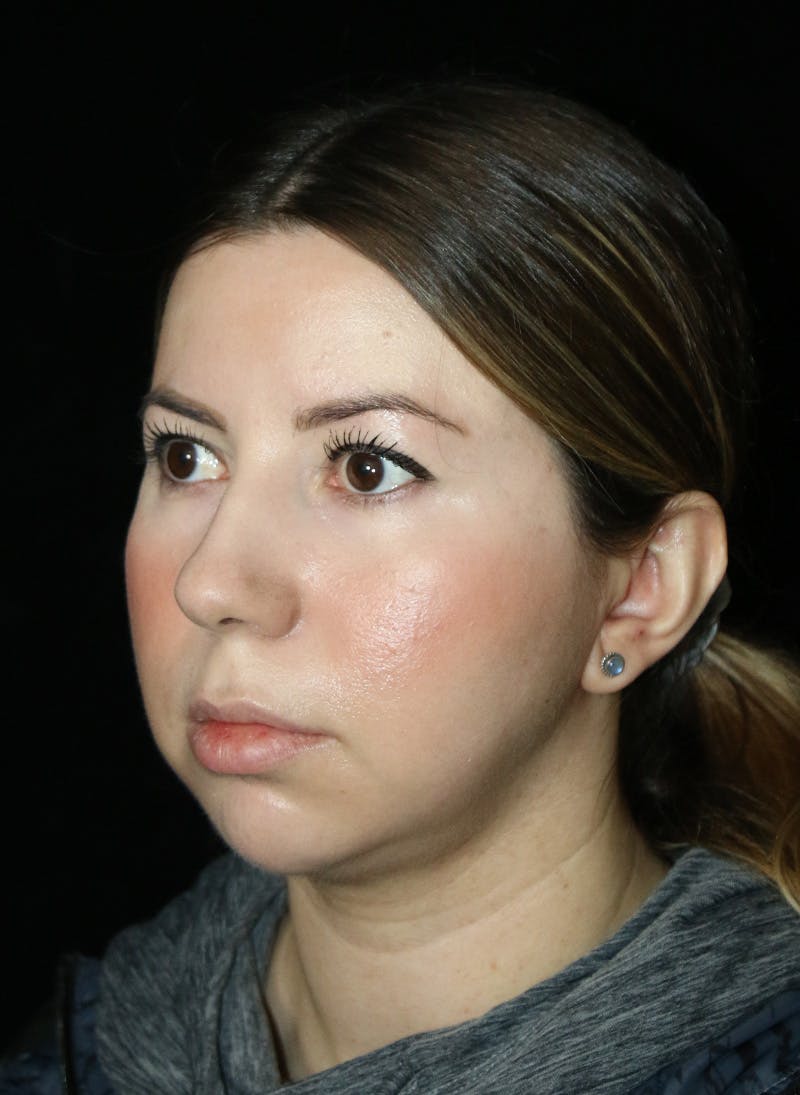 Buccal Fat Restoration Before & After Gallery - Patient 917041 - Image 3