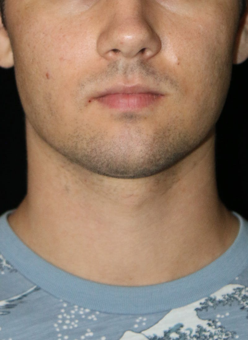 Buccal Fat Restoration Before & After Gallery - Patient 263593 - Image 2