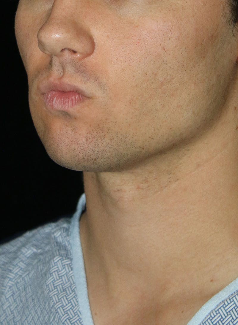 Buccal Fat Restoration Before & After Gallery - Patient 263593 - Image 3