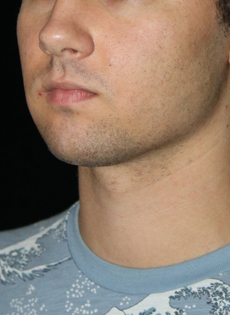 Buccal Fat Restoration Before & After Gallery - Patient 263593 - Image 4