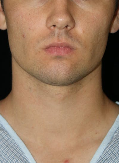 Buccal Fat Restoration Before & After Gallery - Patient 263593 - Image 1