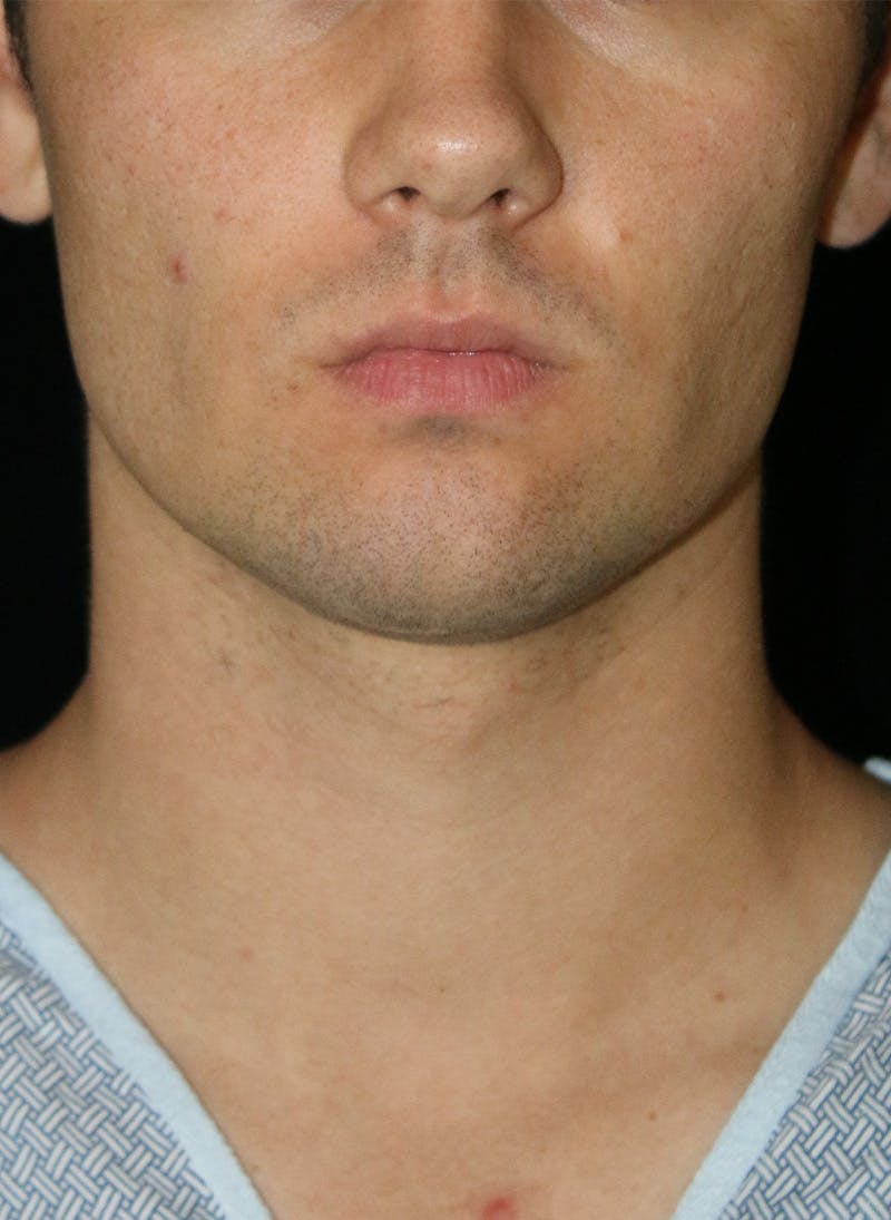 Buccal Fat Restoration Before & After Gallery - Patient 263593 - Image 1