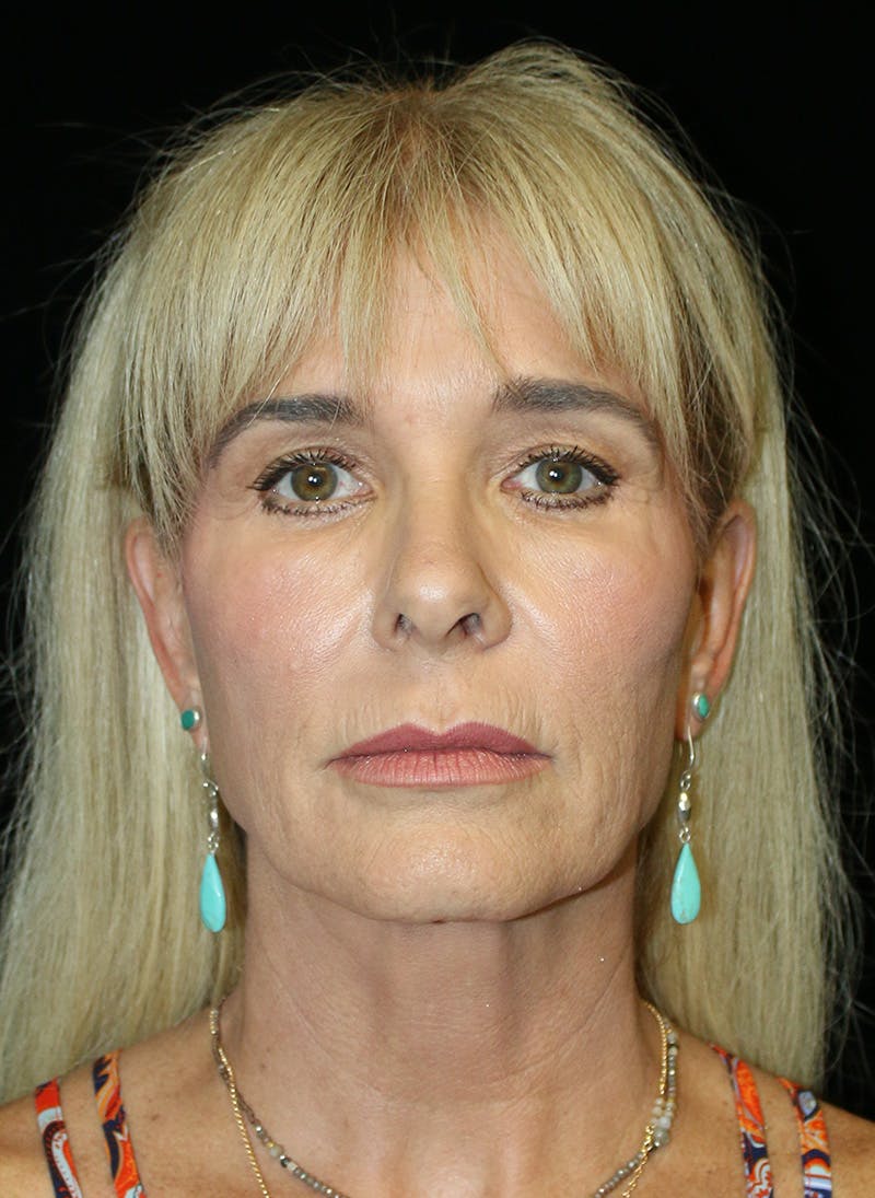Blepharoplasty Before & After Gallery - Patient 248128 - Image 1