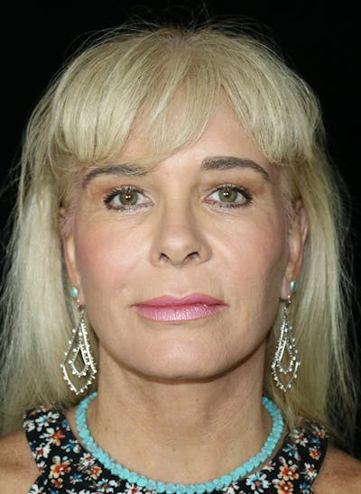 Facelift Before & After Gallery - Patient 232655 - Image 2