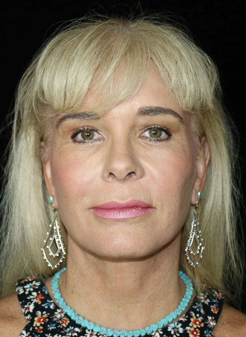 Blepharoplasty Before & After Gallery - Patient 248128 - Image 2