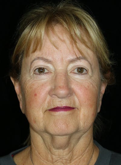Facelift Before & After Gallery - Patient 251827 - Image 1