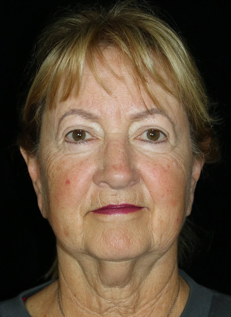Facelift Before & After Gallery - Patient 251827 - Image 1
