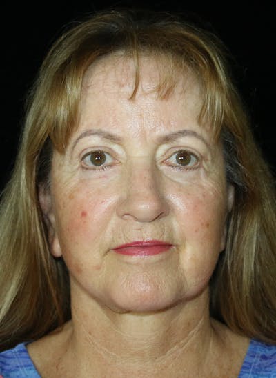 Facelift Before & After Gallery - Patient 251827 - Image 2