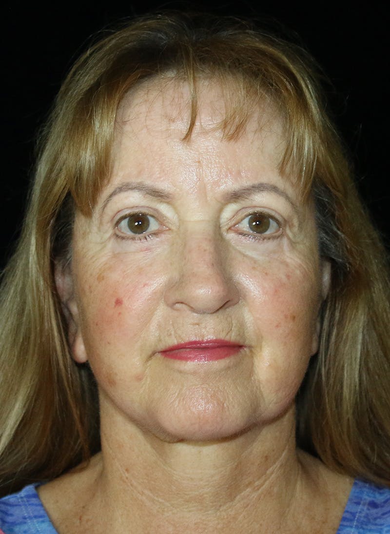 Facelift Before & After Gallery - Patient 251827 - Image 2