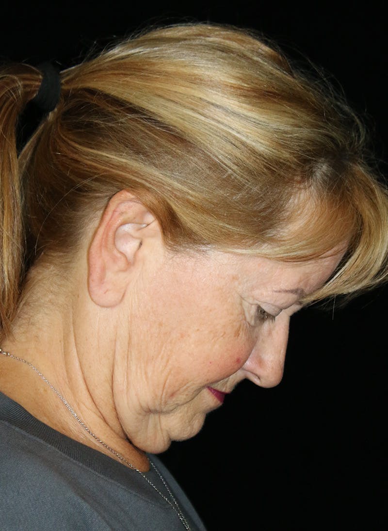 Facelift Before & After Gallery - Patient 251827 - Image 3
