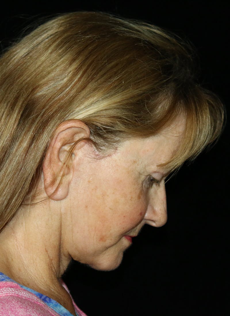 Facelift Before & After Gallery - Patient 251827 - Image 4