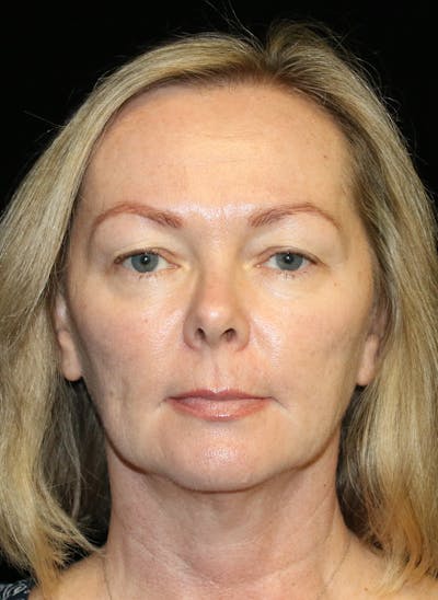 Facial Fat Grafting Before & After Gallery - Patient 193261 - Image 1