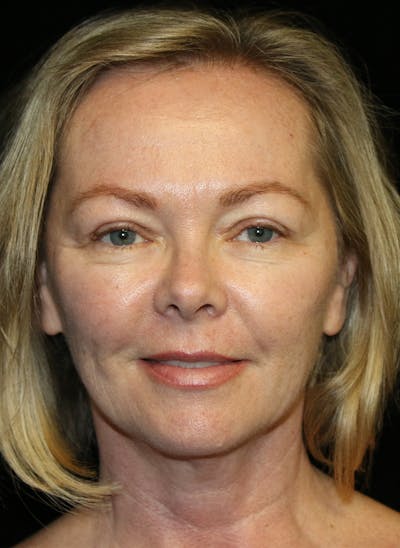 Facial Fat Grafting Before & After Gallery - Patient 193261 - Image 2