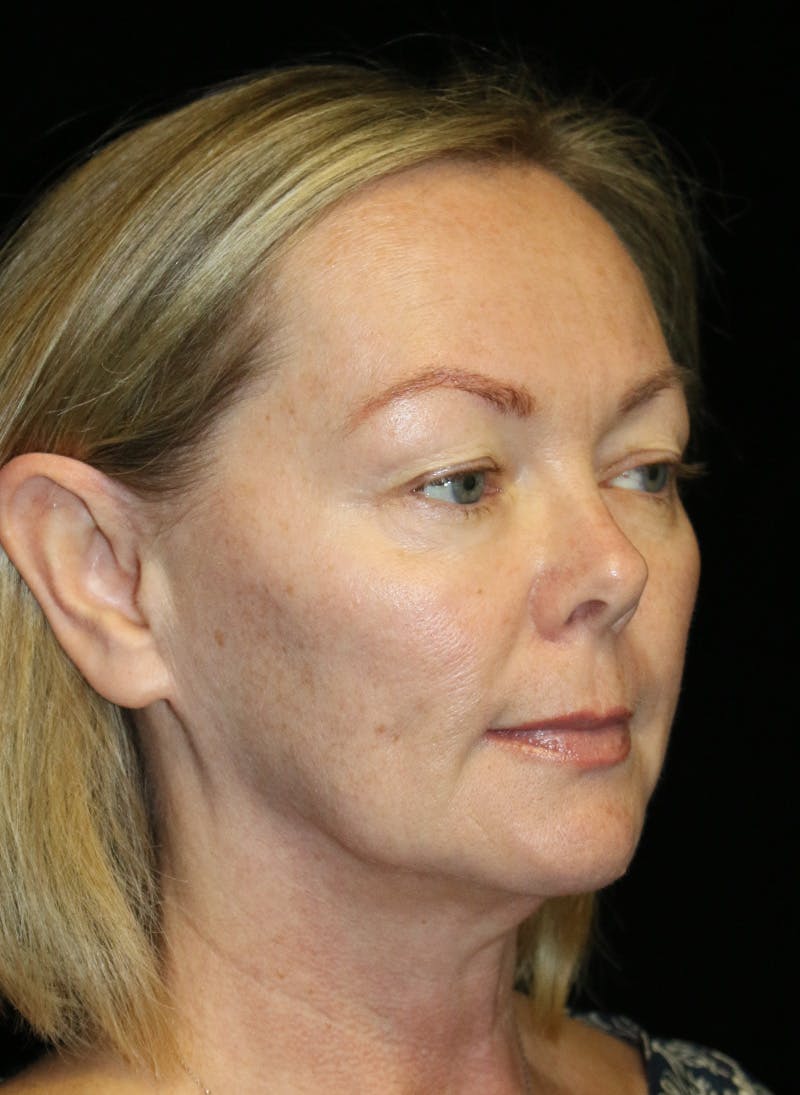 Blepharoplasty Before & After Gallery - Patient 251957 - Image 3