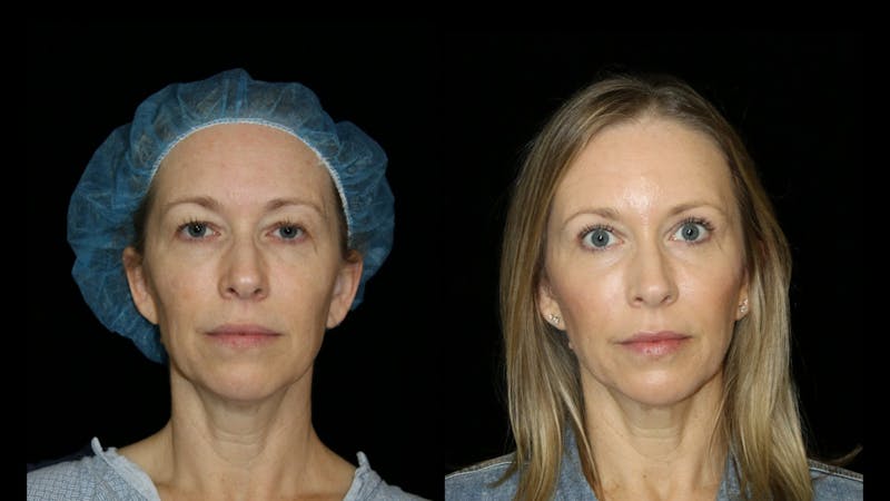 Blepharoplasty Before & After Gallery - Patient 279169 - Image 1
