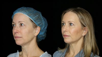 Blepharoplasty Before & After Gallery - Patient 279169 - Image 2