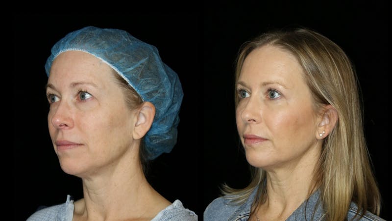 Blepharoplasty Before & After Gallery - Patient 279169 - Image 2