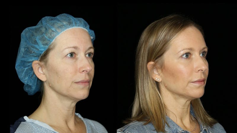 Blepharoplasty Before & After Gallery - Patient 279169 - Image 3