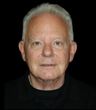 Facelift Before & After Gallery - Patient 714566 - Image 1