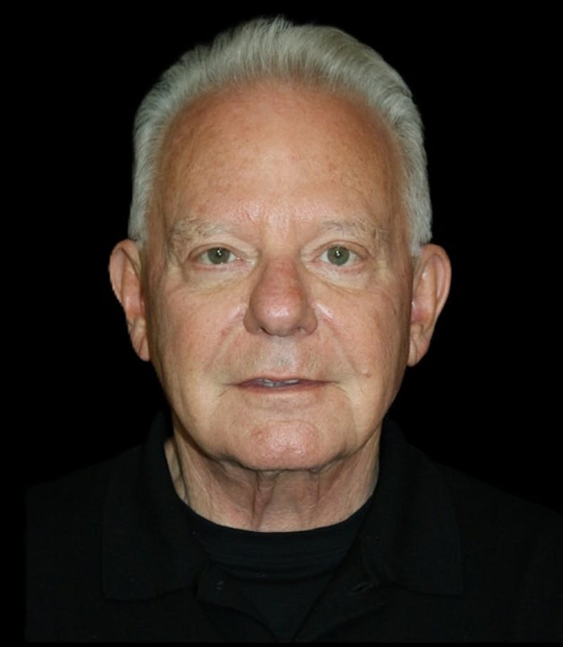 Facelift Before & After Gallery - Patient 714566 - Image 1