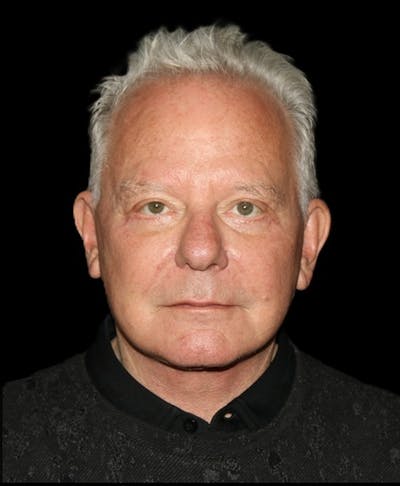 Facelift Before & After Gallery - Patient 714566 - Image 2