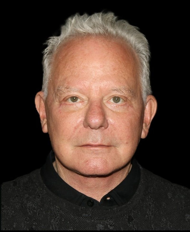 Facelift Before & After Gallery - Patient 714566 - Image 2